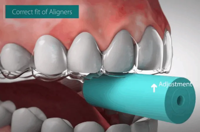 correct fit of aligner