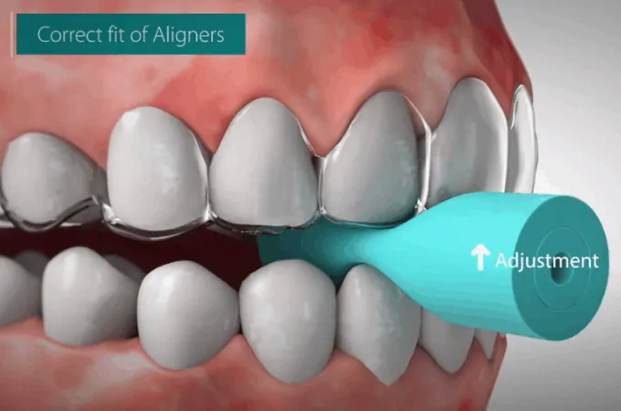correct fit of aligner